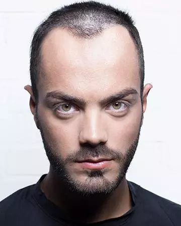05 mens before and after photo 02 solutions before after mens gallery hair loss solutions 05 mens before and after photo 02