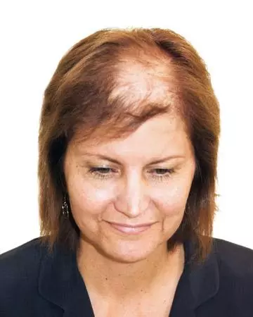   solutions before after womens gallery hair loss solutions 09 womens before and after photo 02