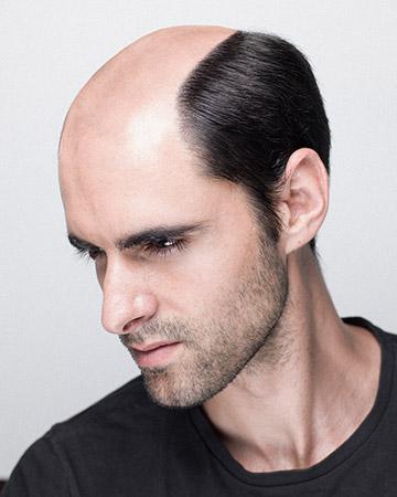   solutions before after mens gallery hair loss solutions 01 mens before and after photo 02