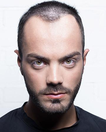 05 mens before and after photo 02 solutions before after mens gallery hair loss solutions 05 mens before and after photo 02