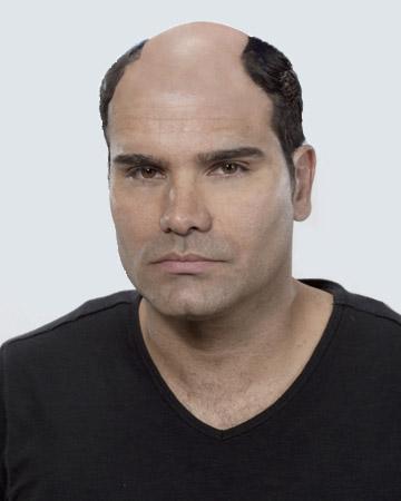 08 mens before and after photo 02 solutions before after mens gallery hair loss solutions 08 mens before and after photo 02