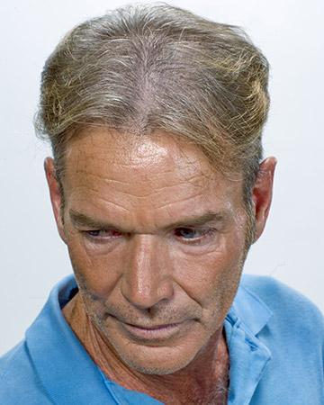   solutions before after mens gallery hair loss solutions 13 mens before and after photo 02
